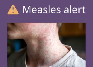 HEALTH ALERT: Measles exposure in Toowoomba